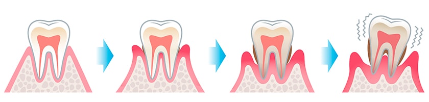 歯周病の発生
